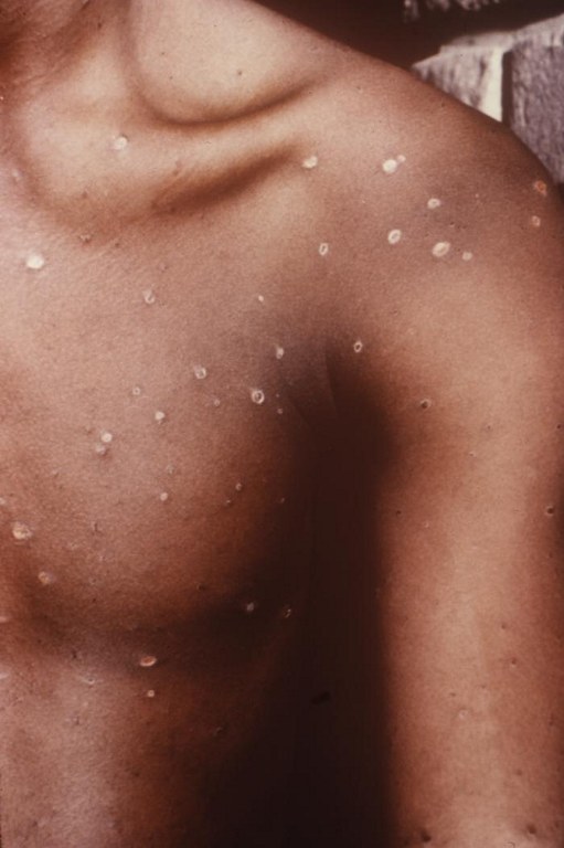 A man's left shoulder and upper chest showing typical day 8 chickenpox, with most scabs having fallen off.
