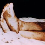 A patient laying on an exam table, with only his legs showing, with plantar foot rash caused by herpes zoster.