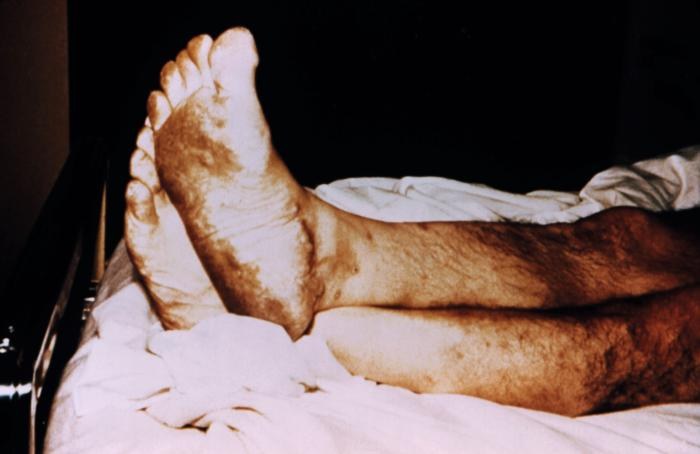 A patient laying on an exam table, with only his legs showing, with plantar foot rash caused by herpes zoster.