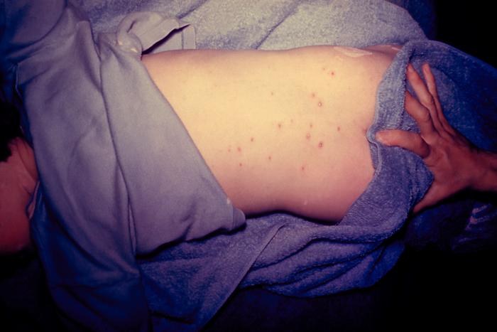 A girl being treated at the hospital with skin lesions on her back due to chickenpox.