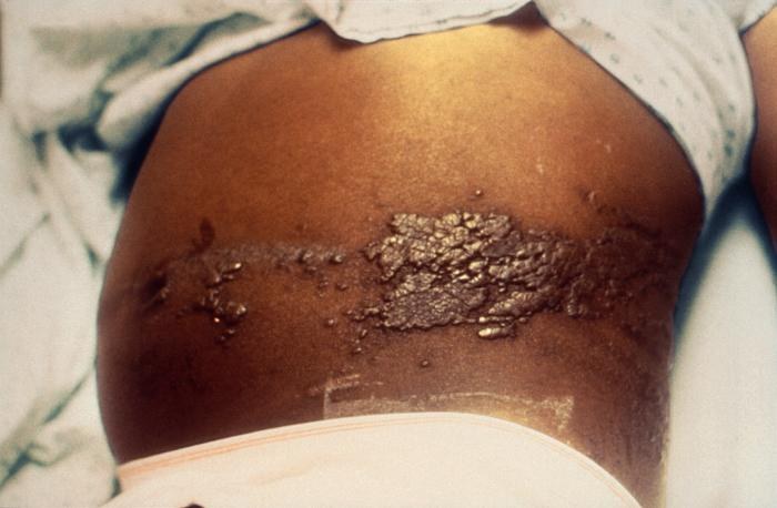 Child with a history of leukemia with a maculopapular rash.