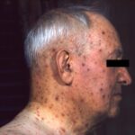 A profile of an elderly man with chickenpox.