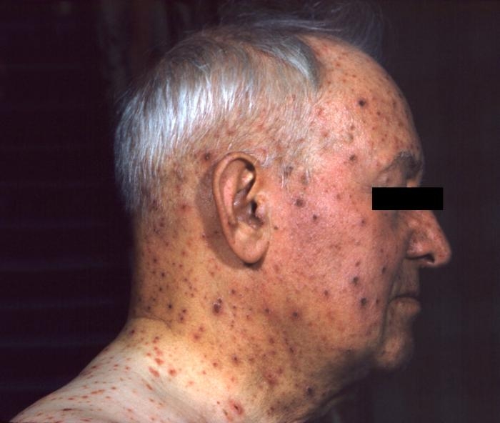 A profile of an elderly man with chickenpox.