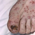 Left foot of elderly man showing spots and dark toenail due to chickenpox.