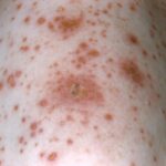 Close-up of the left shoulder region of an elderly man with chickenpox.
