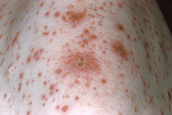 Close-up of the left shoulder region of an elderly man with chickenpox.