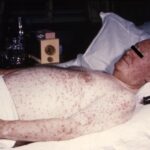 A bedridden, elderly man with chickenpox.