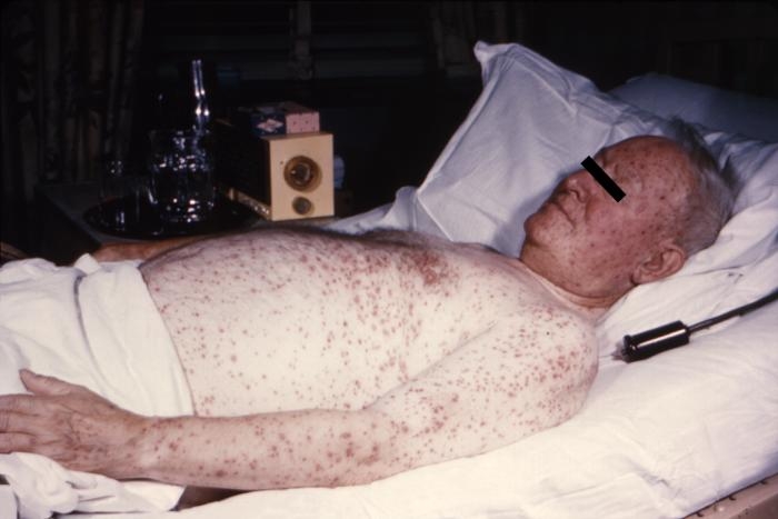 A bedridden, elderly man with chickenpox.