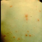 A boy's back showing signs of chickenpox.