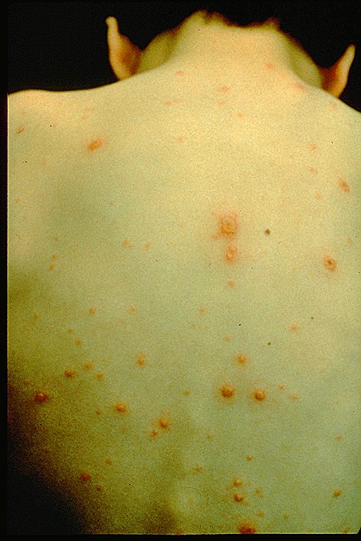 A boy's back showing signs of chickenpox.
