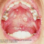An open mouth showing chickenpox on the roof of their mouth.