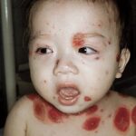 A toddler with bullous chickenpox on the face and upper body.