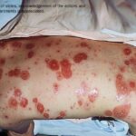 Alternate view of a child in bed on his stomach, showing severe bullous chickenpox.