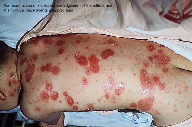 Alternate view of a child in bed on his stomach, showing severe bullous chickenpox.