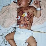 A young boy laying on his back in bed showing hemorrhagic chickenpox on his chest.