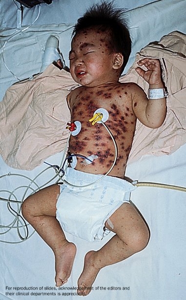 A young boy laying on his back in bed showing hemorrhagic chickenpox on his chest.