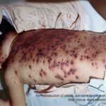 A child in bed on his stomach, showing severe bullous chickenpox.