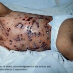 An alternate view of a young child in a hospital bed with his back showing hemorrhagic chickenpox.