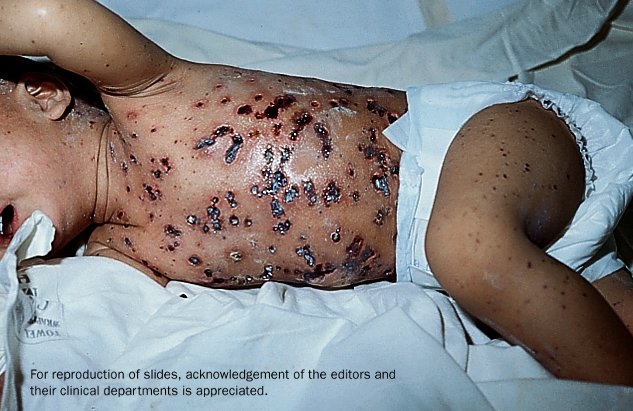 An alternate view of a young child in a hospital bed with his back showing hemorrhagic chickenpox.