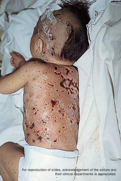 A young child in a hospital bed with his back showing hemorrhagic chickenpox.