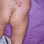 Child with signs and symptoms of herpes zoster (shingles) on their lower back.