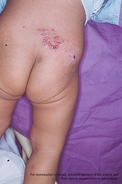 Child with signs and symptoms of herpes zoster (shingles) on their lower back.