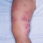 Child with signs and symptoms of herpes zoster (shingles) on their thighs.