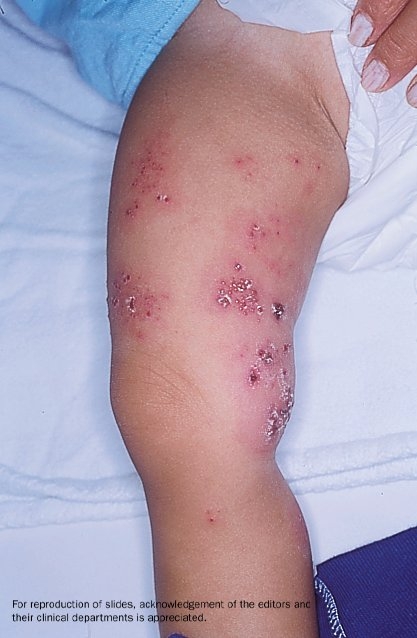 Child with signs and symptoms of herpes zoster (shingles) on their thighs.