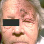 Herpes zoster (shingles) on the face of an older woman.