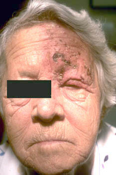 Herpes zoster (shingles) on the face of an older woman.