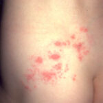Herpes zoster (shingles) on a patient's shoulder.