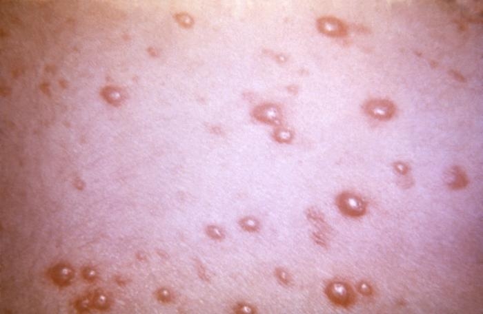 Close-up of the shingles disease.